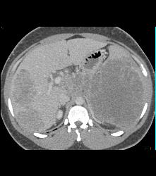 Kaposi Sarcoma in Liver and Spleen- Amazing - CTisus CT Scan