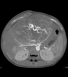 Leiomyosarcoma of the Liver - CTisus CT Scan