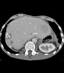 Recurrent Hepatocellular Carcinoma (Hepatoma) - CTisus CT Scan