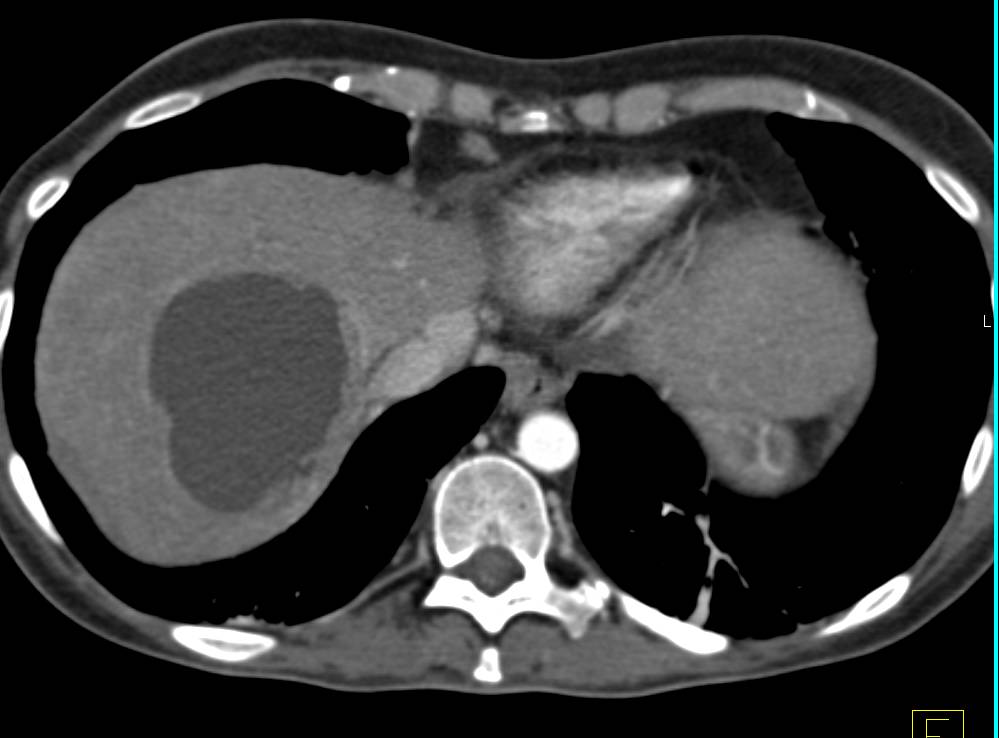Cholangiocarcinoma with Tumor in Porta Encasing the Portal vein - CTisus CT Scan