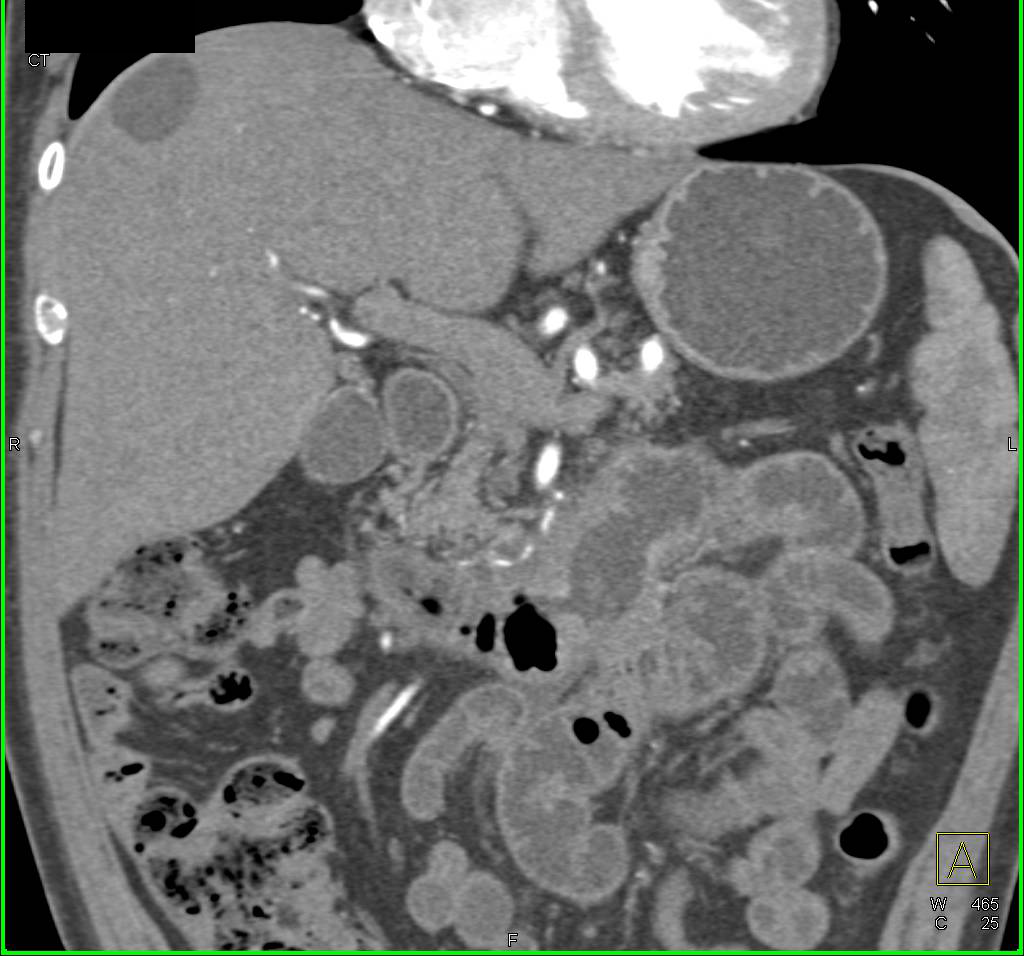 3D Visualization of Normal Common Bile Duct - CTisus CT Scan