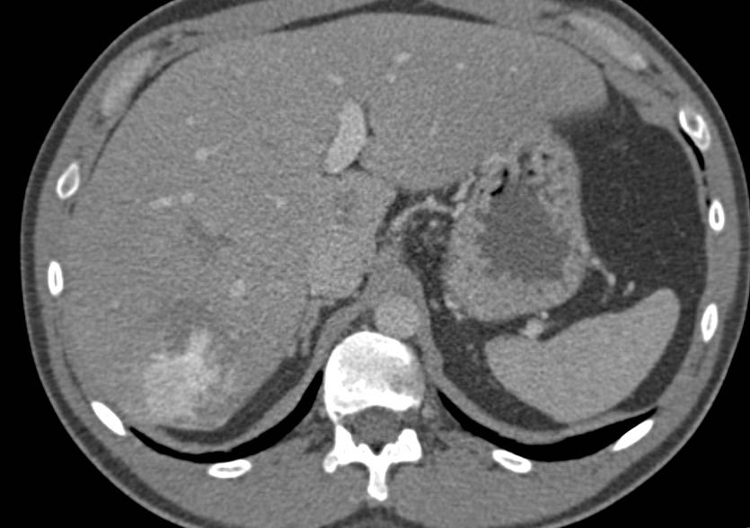 Hepatic Focal Nodular Hyperplasia - CTisus CT Scan