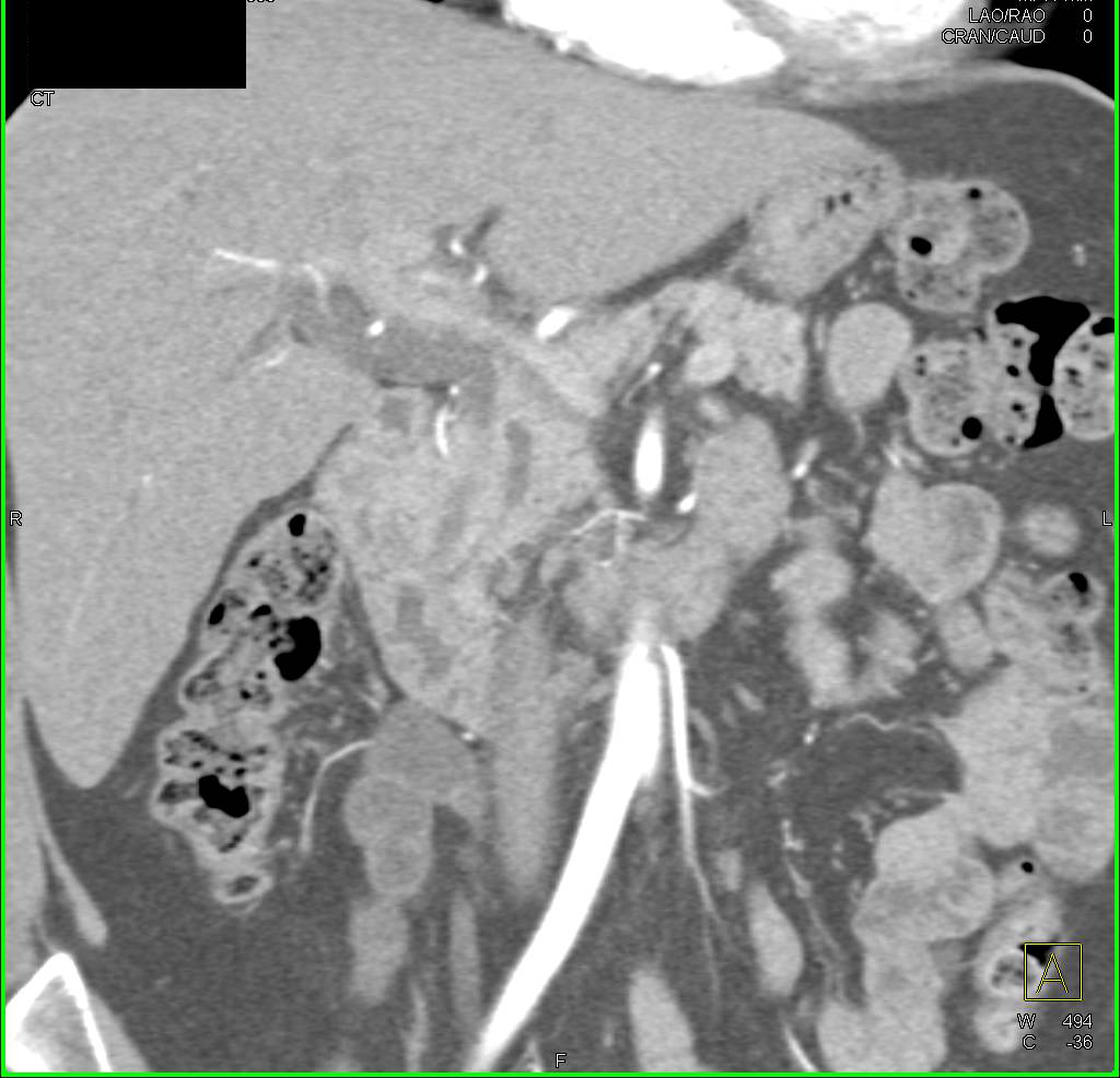 Ampullary Carcinoma with Double Duct Sign - CTisus CT Scan