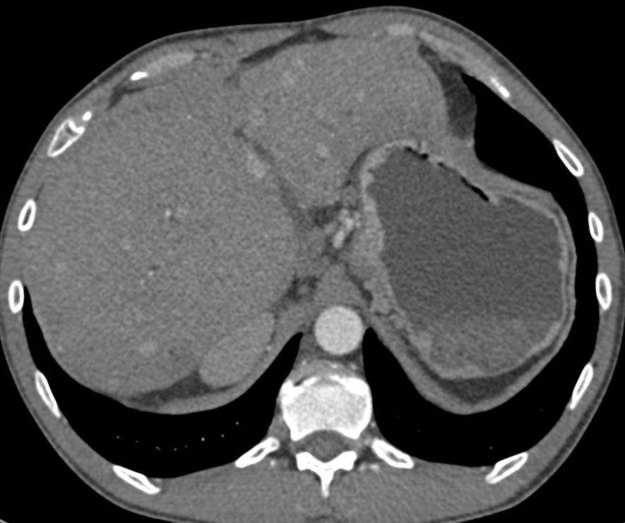 Vascular Liver Metastases from Carcinoid Tumor - CTisus CT Scan