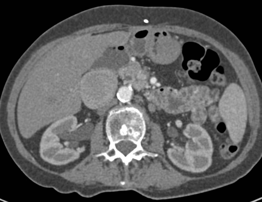 Portal Vein Aneurysm - CTisus CT Scan