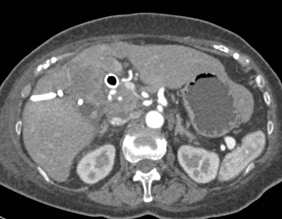 Gallbladder Cancer Invades the Liver with Liver Metastases - CTisus CT Scan