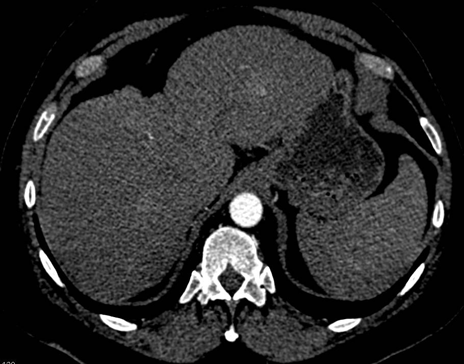 Hepatic Arterial Mapping - CTisus CT Scan