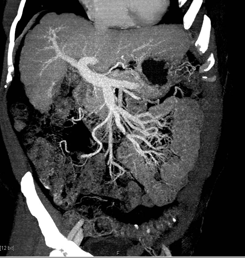 Cirrhosis with Portal Hypertension and Varices - CTisus CT Scan