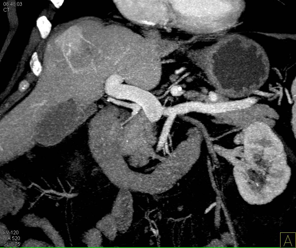Hepatic Adenoma with Bleed - CTisus CT Scan