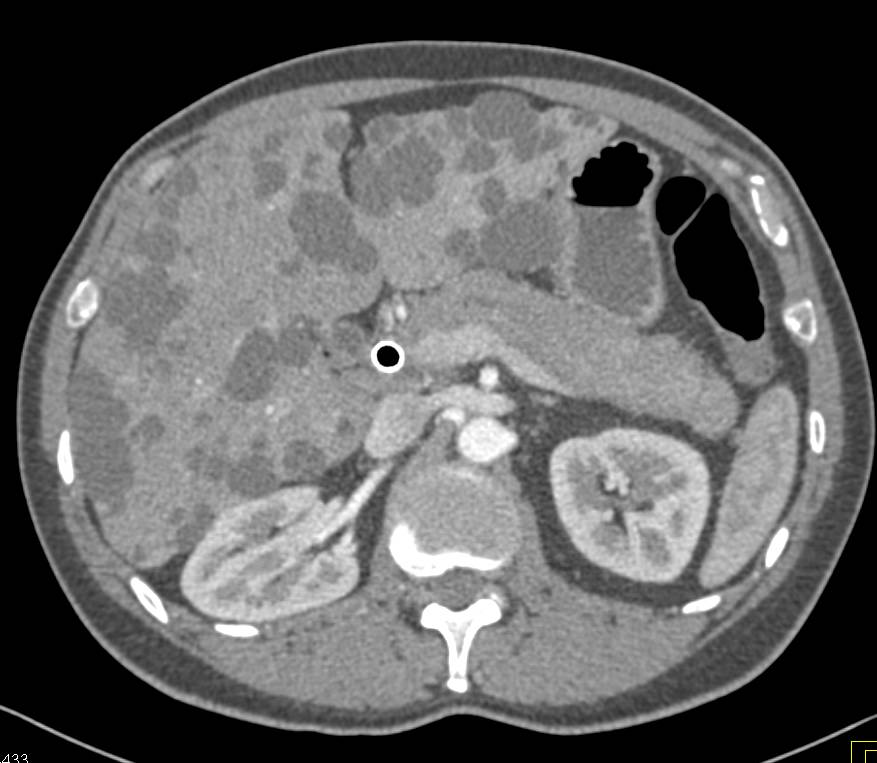 Polycystic Liver Disease with Common Bile Duct (CBD) Stent - CTisus CT Scan