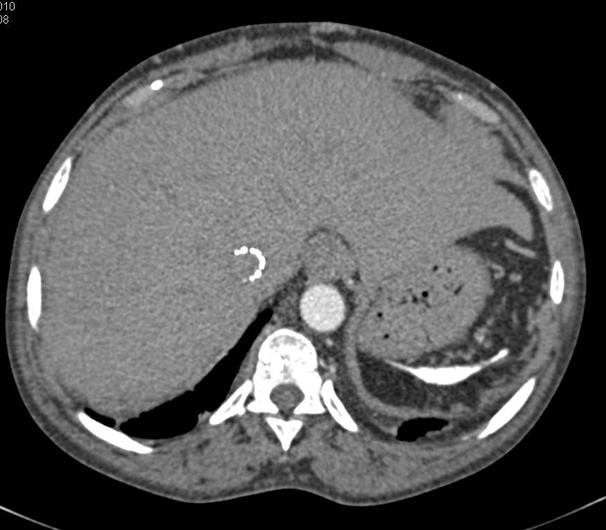 Sickle Cell Disease with Occluded Inferior Vena Cava (IVC) -SMV Shunt - CTisus CT Scan