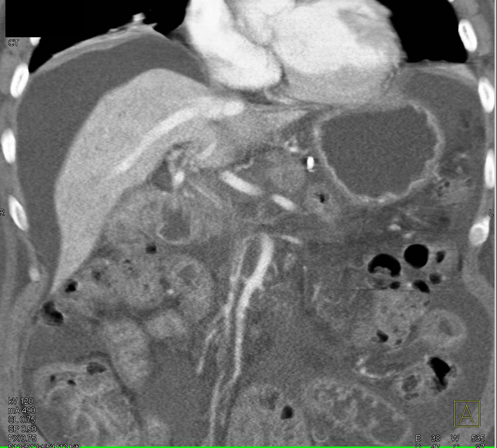 Cirrhosis and Ascites - CTisus CT Scan