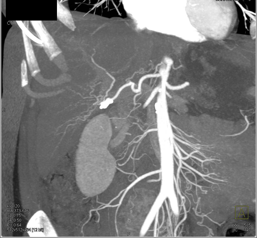 CTA of the Liver with Parenchymal Liver Disease - CTisus CT Scan