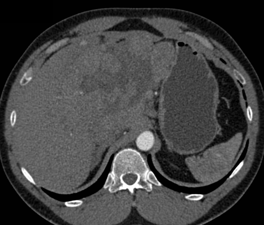 Hepatocellular Carcinoma (Hepatoma) with Neovascularity and Multiphase Display - CTisus CT Scan