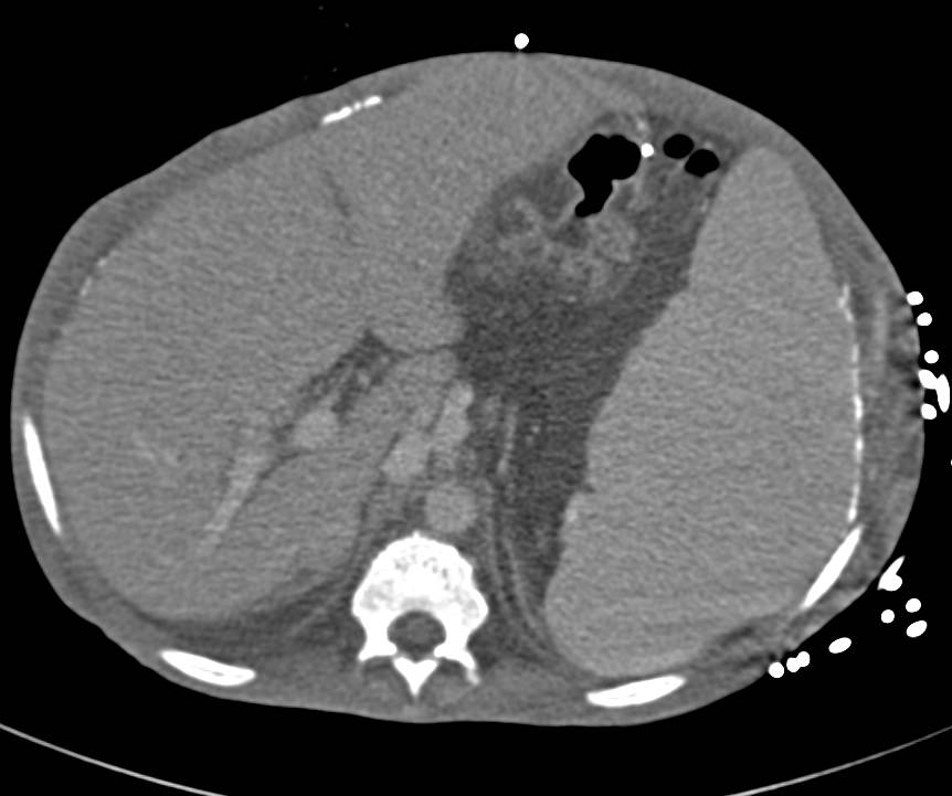 Hepatocellular Carcinoma (Hepatoma) in Right Lobe of Liver Arising in Cirrhotic Liver with Portal Hypertension. Patient has Splenomegaly and Huge Varices. - CTisus CT Scan