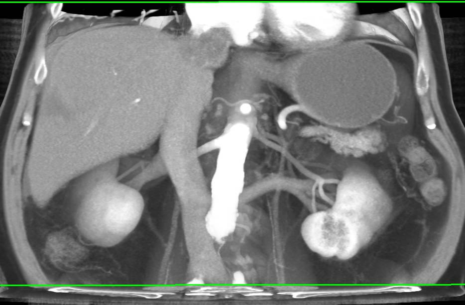 Multifocal Hepatocellular Carcinoma (Hepatoma) with Inferior Vena Cava (IVC) Extension - CTisus CT Scan
