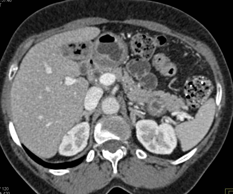 Cholesterol Gallstones - CTisus CT Scan