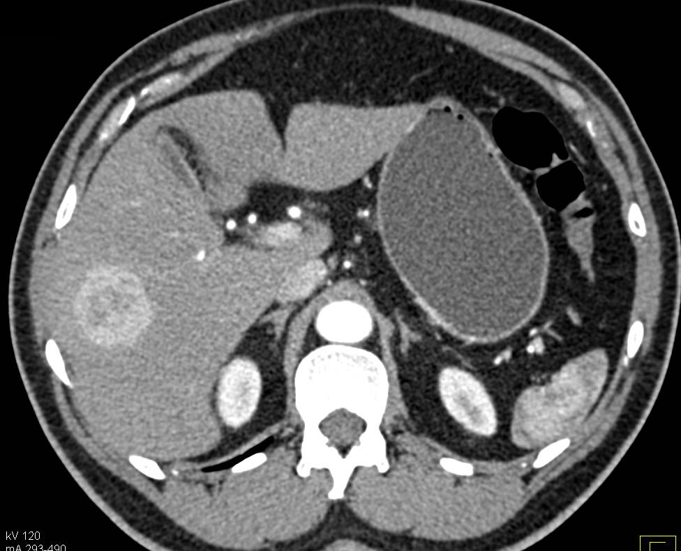 Focal Nodular Hyperplasia (FNH) - CTisus CT Scan