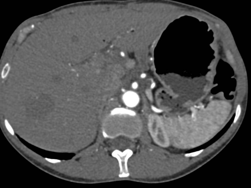 Classic Hepatic Hemangioma - CTisus CT Scan