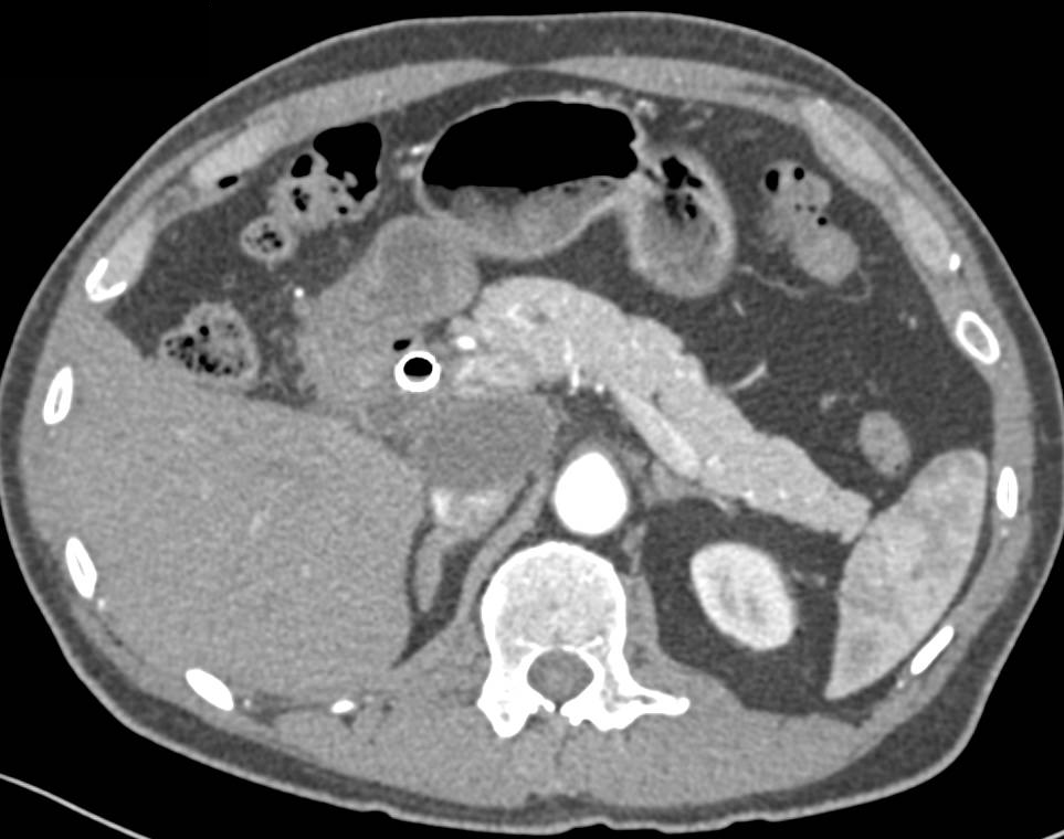 Cholangiocarcinoma with Stent and Bulky Nodes in Porta Hepatitis - CTisus CT Scan