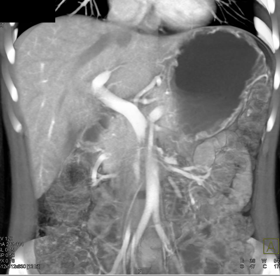 Portal Venous Anatomy - CTisus CT Scan