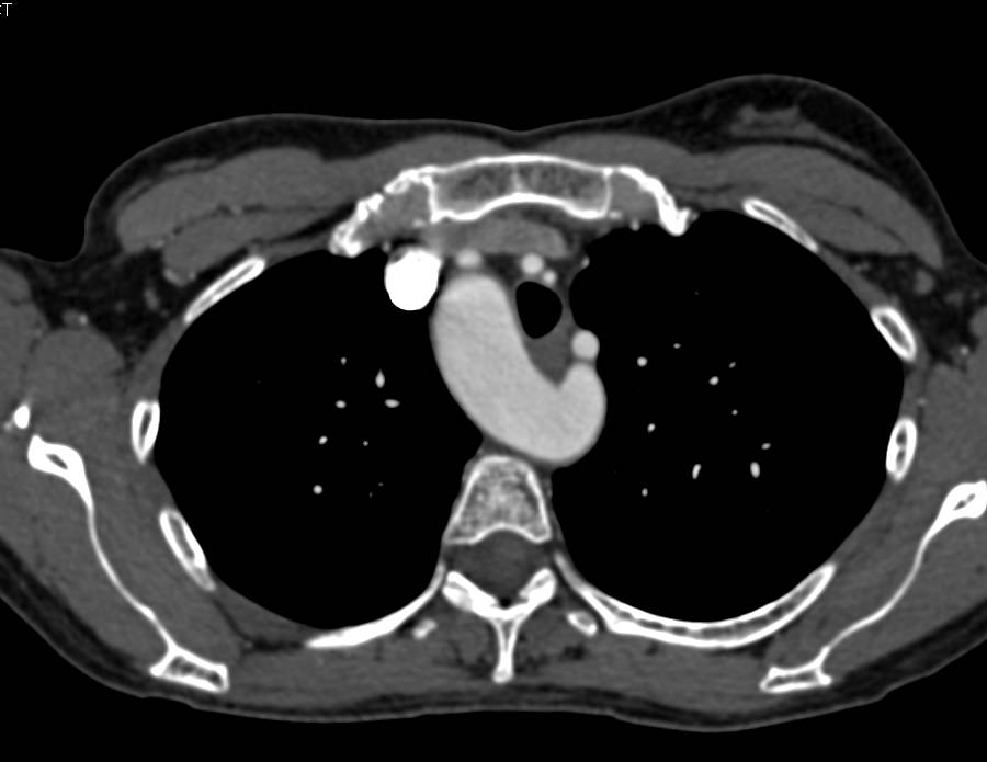 Hereditary Hemorrhagic Telangiectasia (HHT) with Multiple Arteriovenous Malformations (AVMs) in the Liver. Nice Right Sided Aortic Arch - CTisus CT Scan