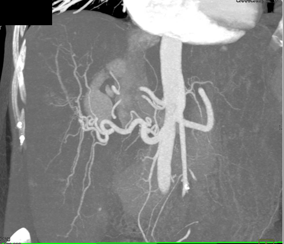 Subtle Hepatocellular Carcinoma (Hepatoma) in a Cirrhotic Liver Best Seen on CT Angiography Views - CTisus CT Scan