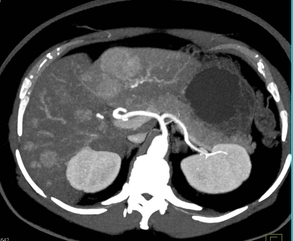 Liver Metastases with Spontaneous Bleed - CTisus CT Scan