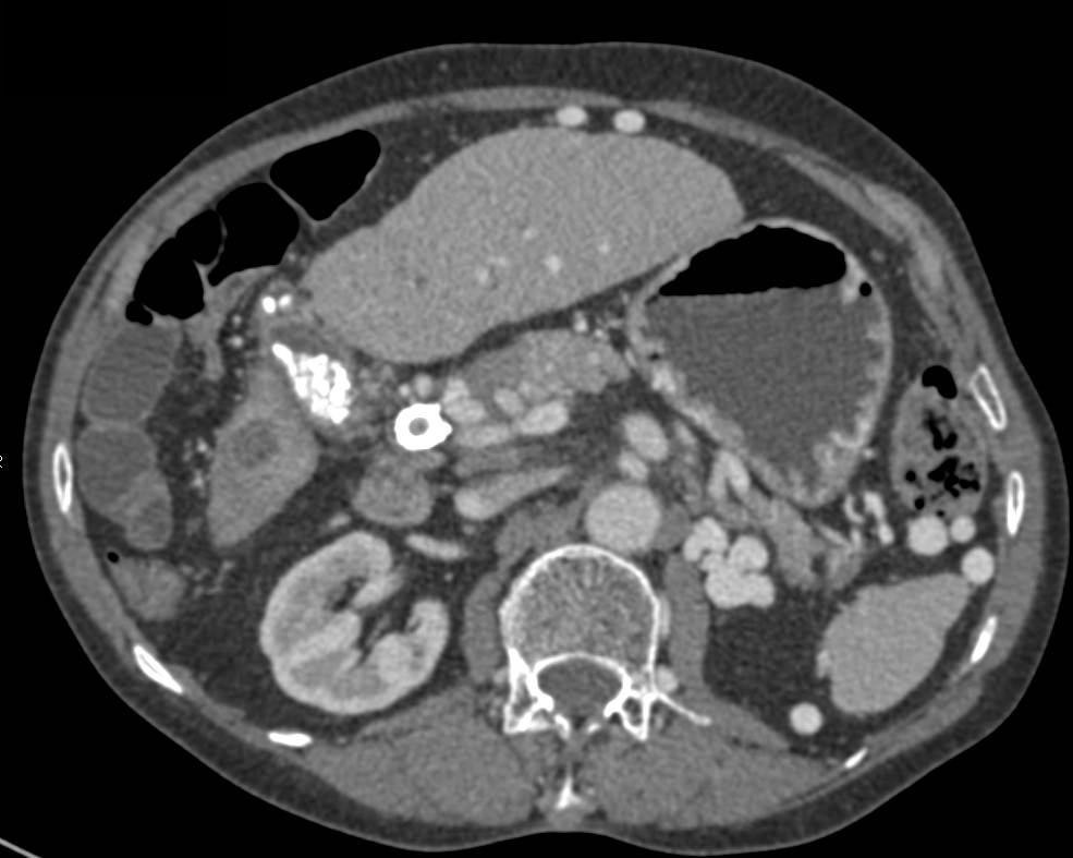 Cirrhosis with Transjugular Intrahepatic Portosystemic Shunt (TIPS) and Beautiful Example of Recanalized Umbilical Vein - CTisus CT Scan