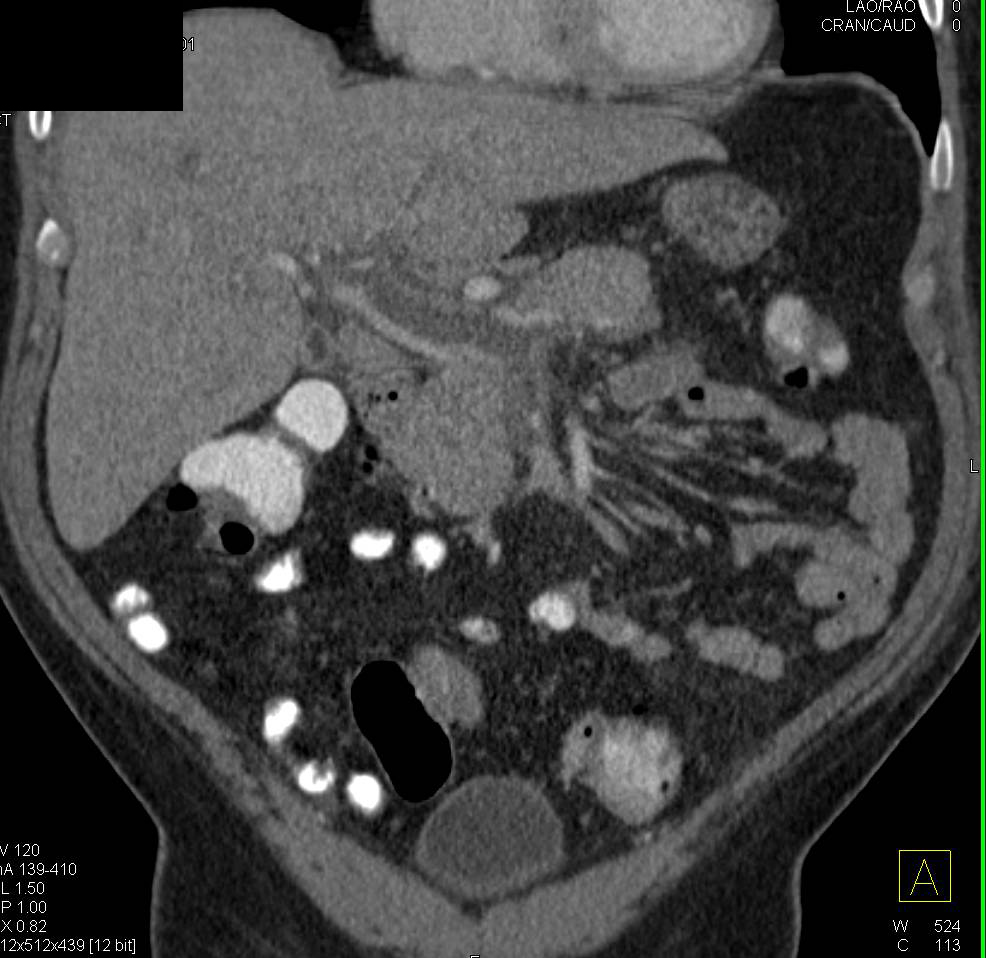 Portal Vein Thrombosis Extends into the Superior Mesenteric Vein (SMV) - CTisus CT Scan