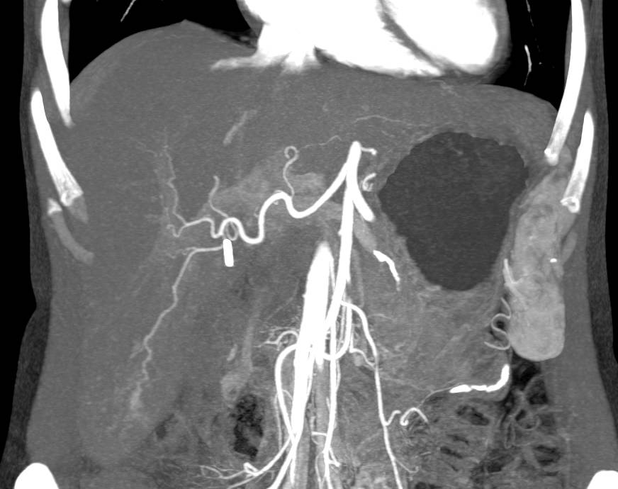 Hemangioma on CTA of the LIver - CTisus CT Scan