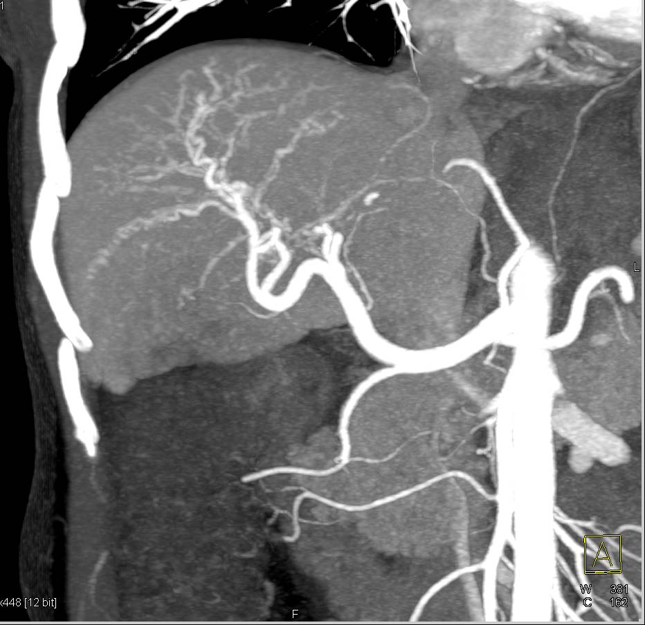 Cirrhosis with Portal Hypertension and Large Esophageal and Gastric Varices - CTisus CT Scan