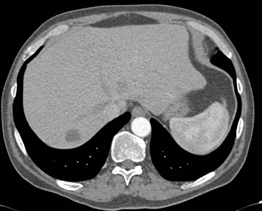 Liver Abscess - CTisus CT Scan