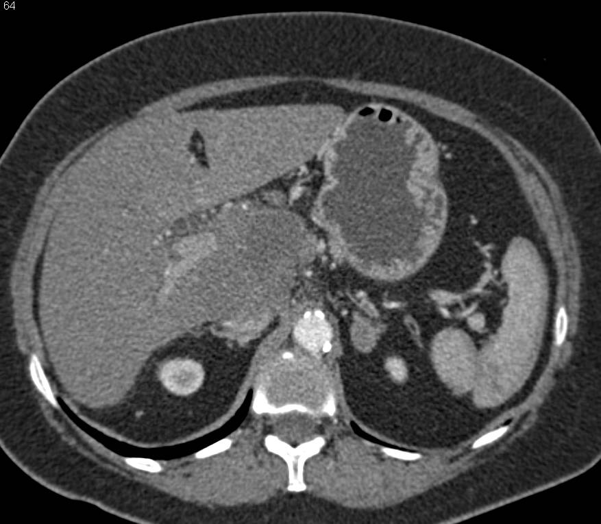 Cholangiocarcinoma Infiltrates Porta Hepatis with Encasement of the Portal Vein and Hepatic Artery - CTisus CT Scan