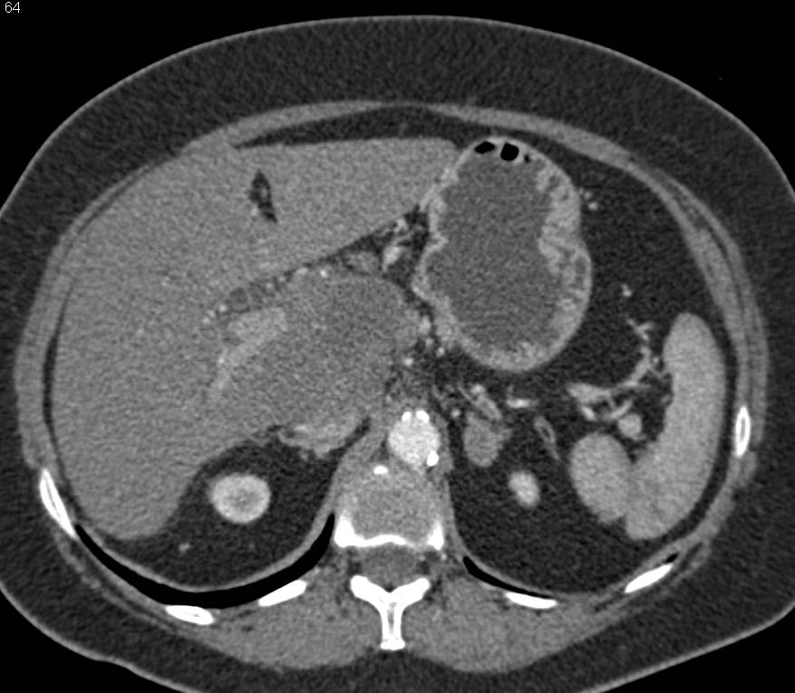 Cholangiocarcinoma Infiltrates Porta Hepatis with Encasement of the Portal Vein and Hepatic Artery - CTisus CT Scan