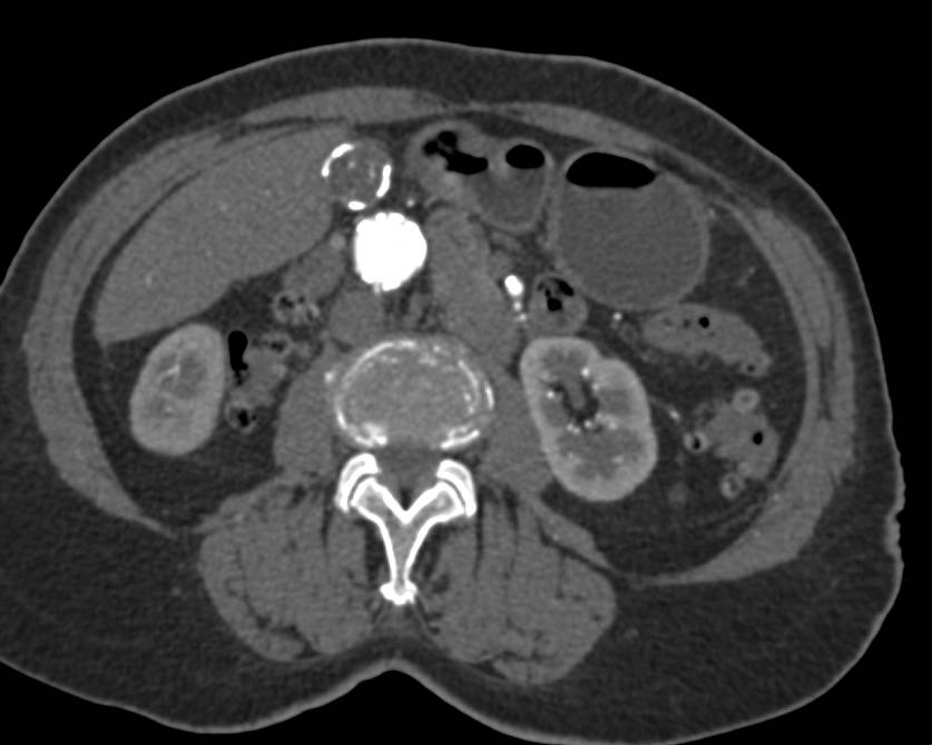 Gallbladder Cancer at Pathology in this Partially Calcified Gallbladder - CTisus CT Scan