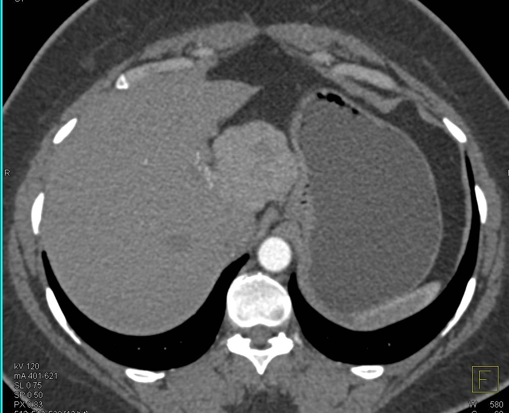 Very Usual Case of Focal Nodular Hyperplasia of the Liver Presenting as a Pancreatic Mass - CTisus CT Scan