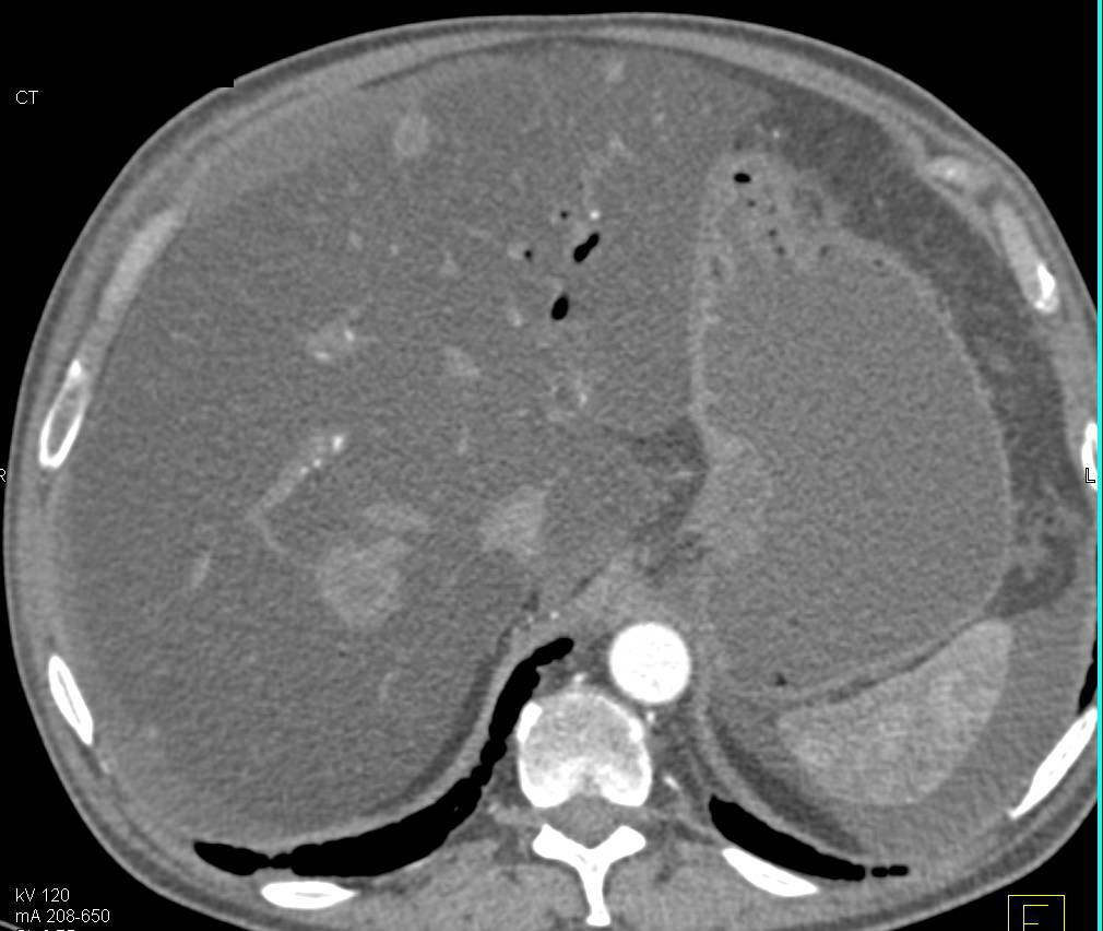 Liver Metastases in a Fatty Liver in a Patient with Pancreatic Cancer