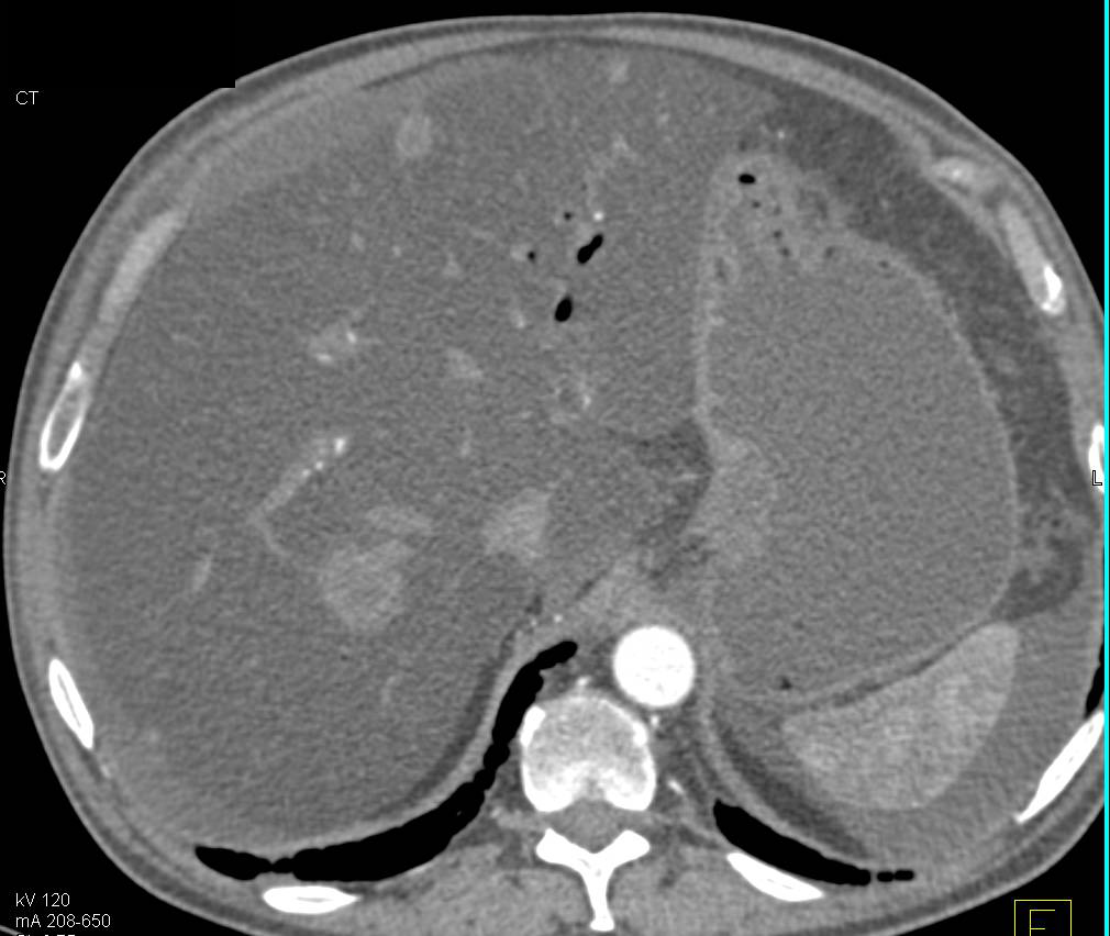 Liver Metastases in a Fatty Liver in a Patient with Pancreatic Cancer - CTisus CT Scan