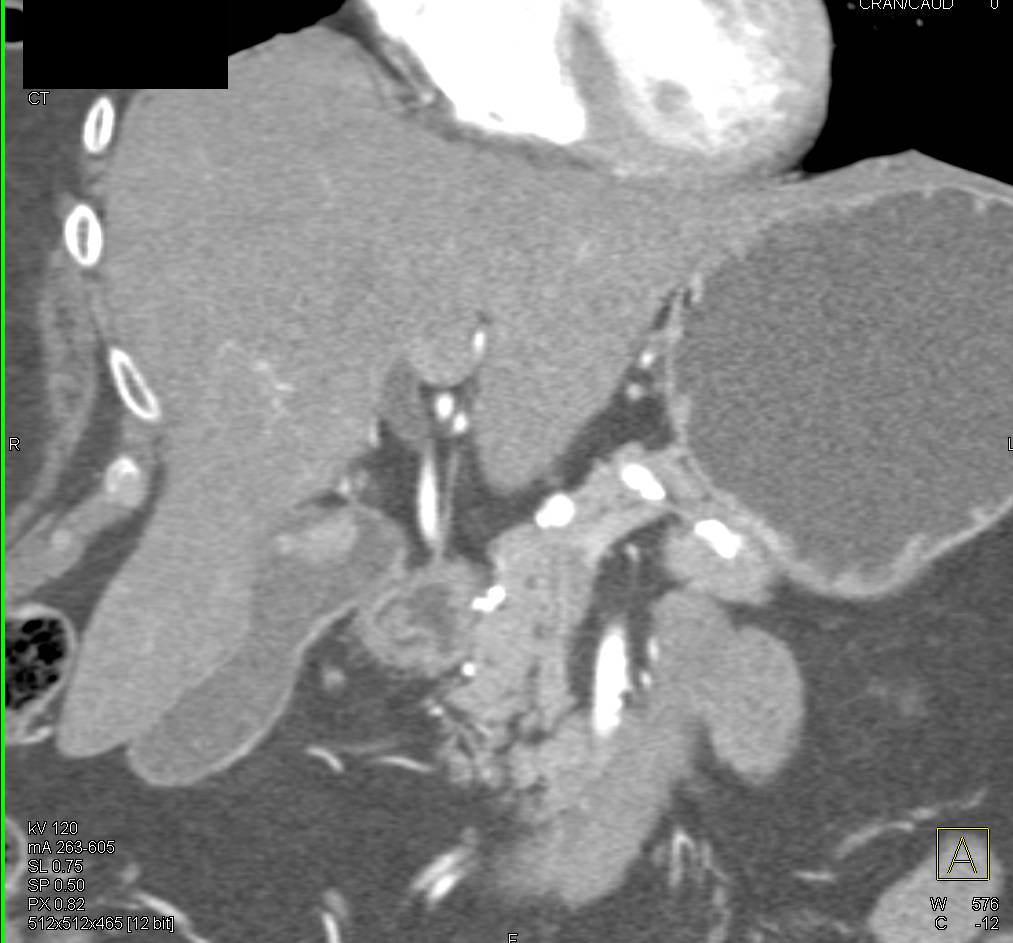 Polyp in the Gallbladder - CTisus CT Scan