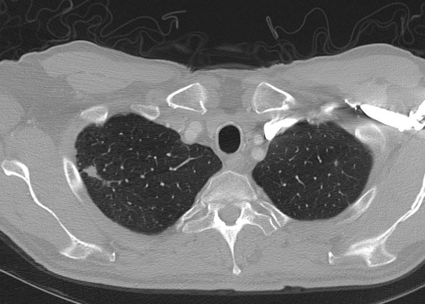 Liver and Lung Metastases from Pancreatic Cancer - CTisus CT Scan