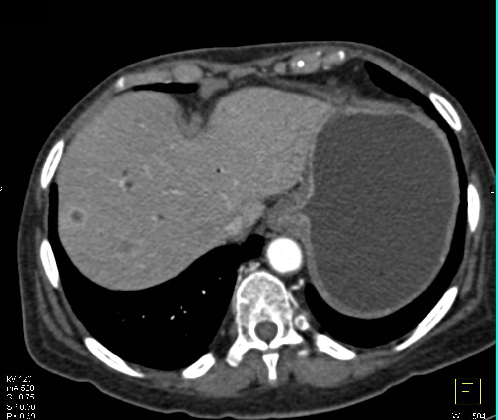 Liver Metastases From Pancreatic Adenocarcinoma - CTisus CT Scan