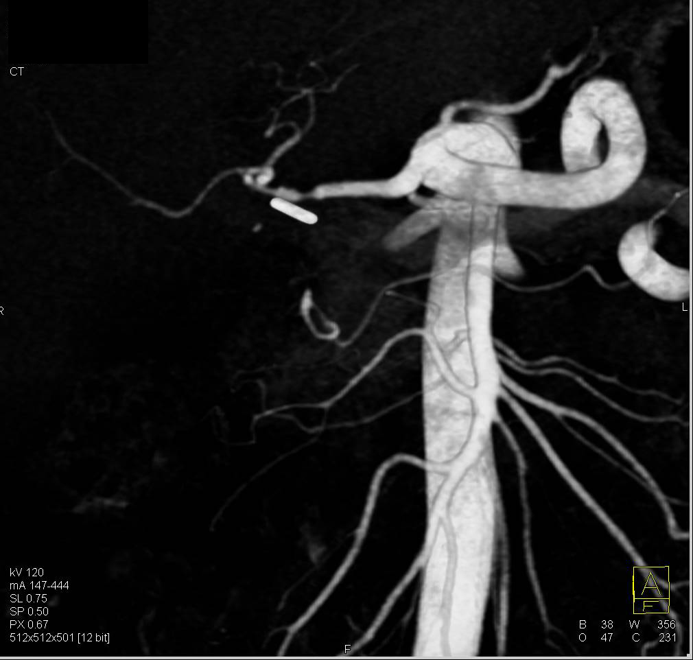 Hepatic Artery Stenosis in a Liver Transplant Patient - CTisus CT Scan