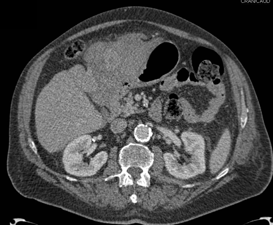 Hepatocellular Carcinoma (Hepatoma) Presents with Spontaneous Bleed - CTisus CT Scan