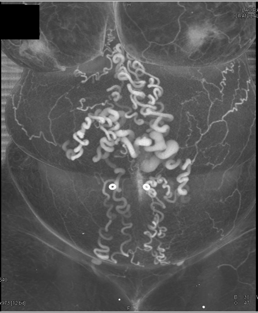 Portal Hypertension and Recanalization of the Umbilical Vein with Huge Varices - CTisus CT Scan