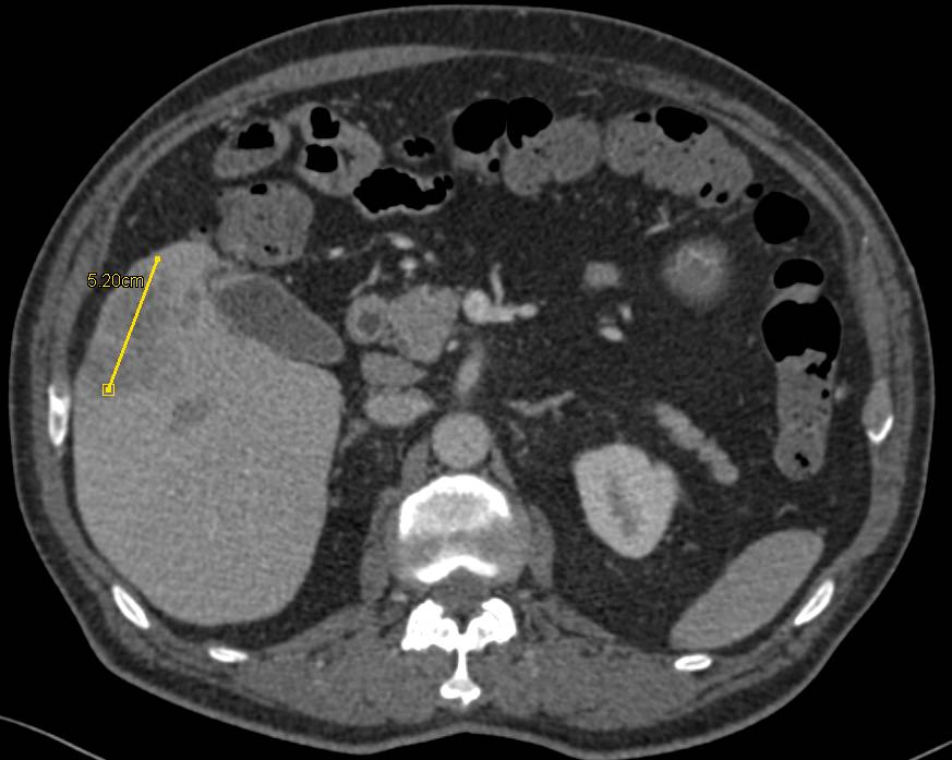 Intrahepatic Cholangiocarcinoma - CTisus CT Scan
