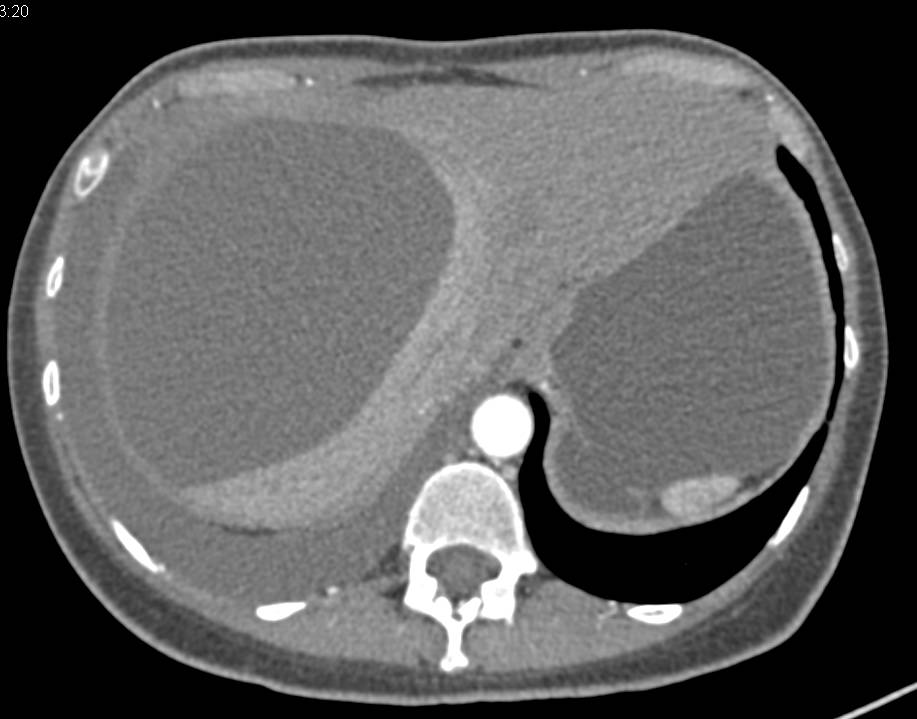 Biloma - CTisus CT Scan
