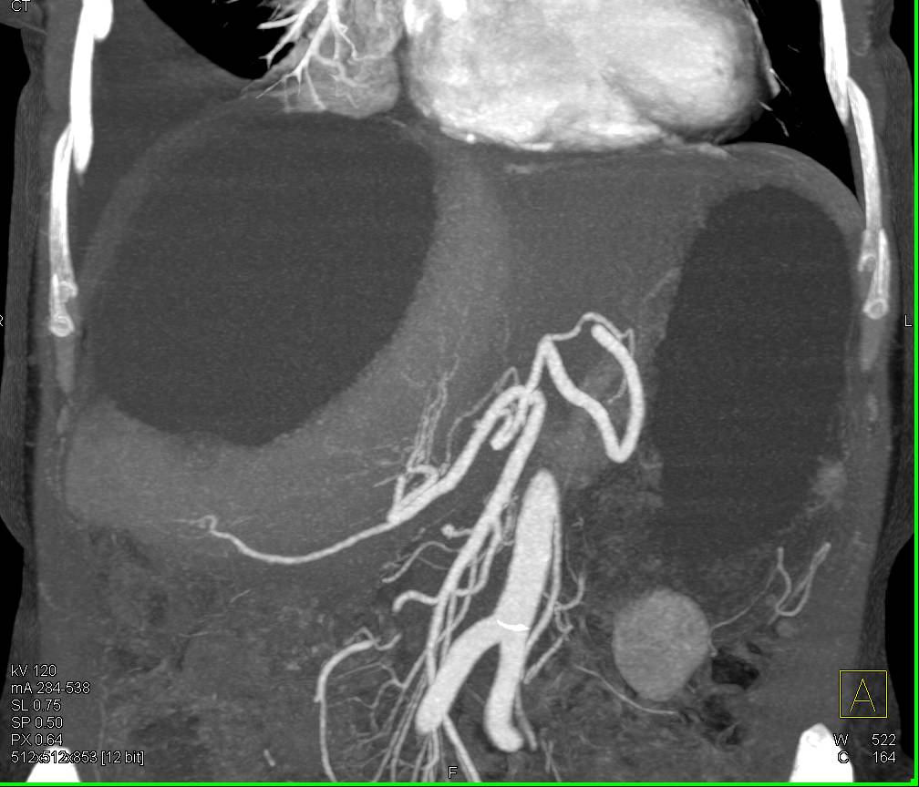 Large Biloma - CTisus CT Scan