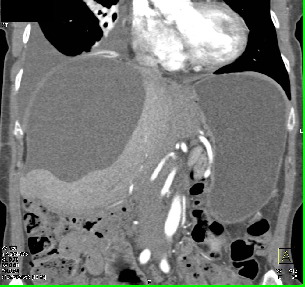 Biloma - CTisus CT Scan