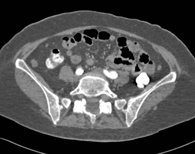 Metastatic Melanoma with Lung, Bone, Liver and Subcutaneous Nodules - CTisus CT Scan